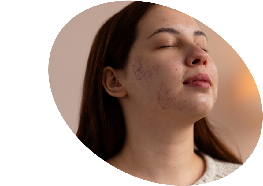 Acne Skincare - Shop Serums &amp; Creams for Acne &amp; Pimples Austria