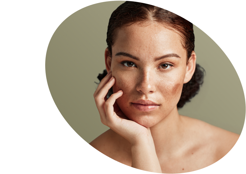 Manchas  Oscuras  e Hiperpigmentación  Facial  - Compre  Productos  Iluminadores  España