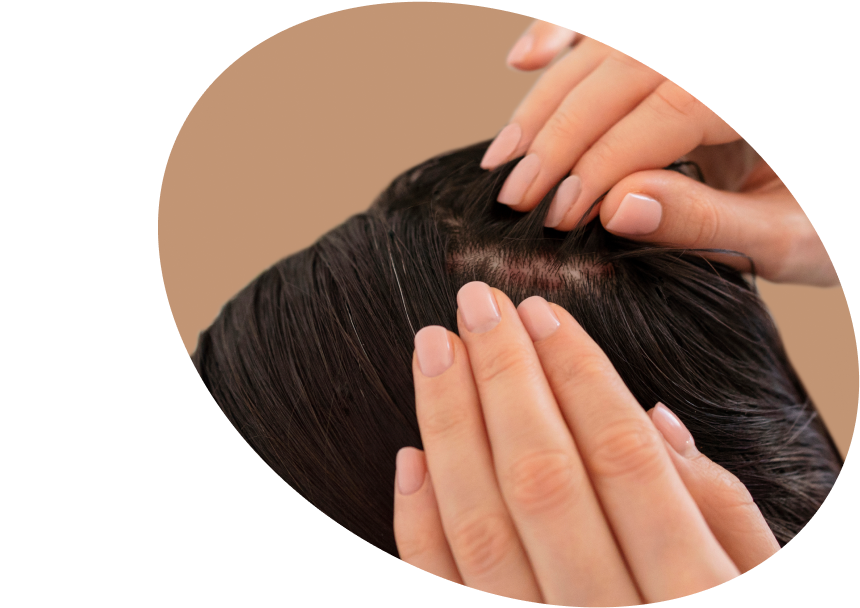 Scalp  Psoriasis  Solutions  Shop:  Lättnad  för Psoriasis  i Hårbotten  Sverige