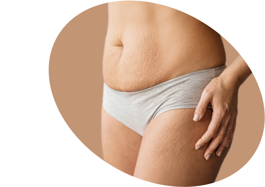 Stretch Marks - Shop Creams to Prevent &amp; Treat Stretch Marks Fiji