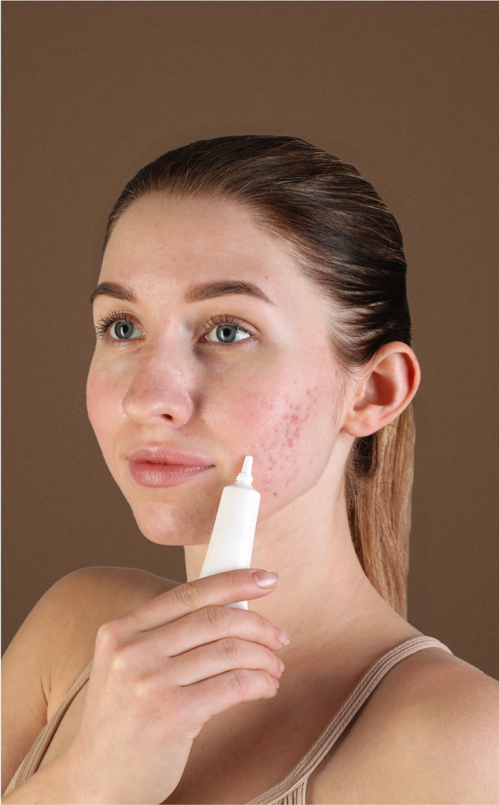 Everything you need for Acne Skin Prone