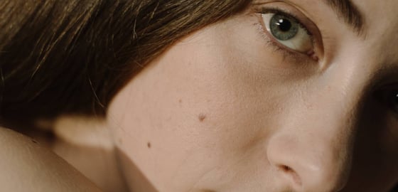 Rosacea Skincare: A Guide Featuring Symptoms & Causes