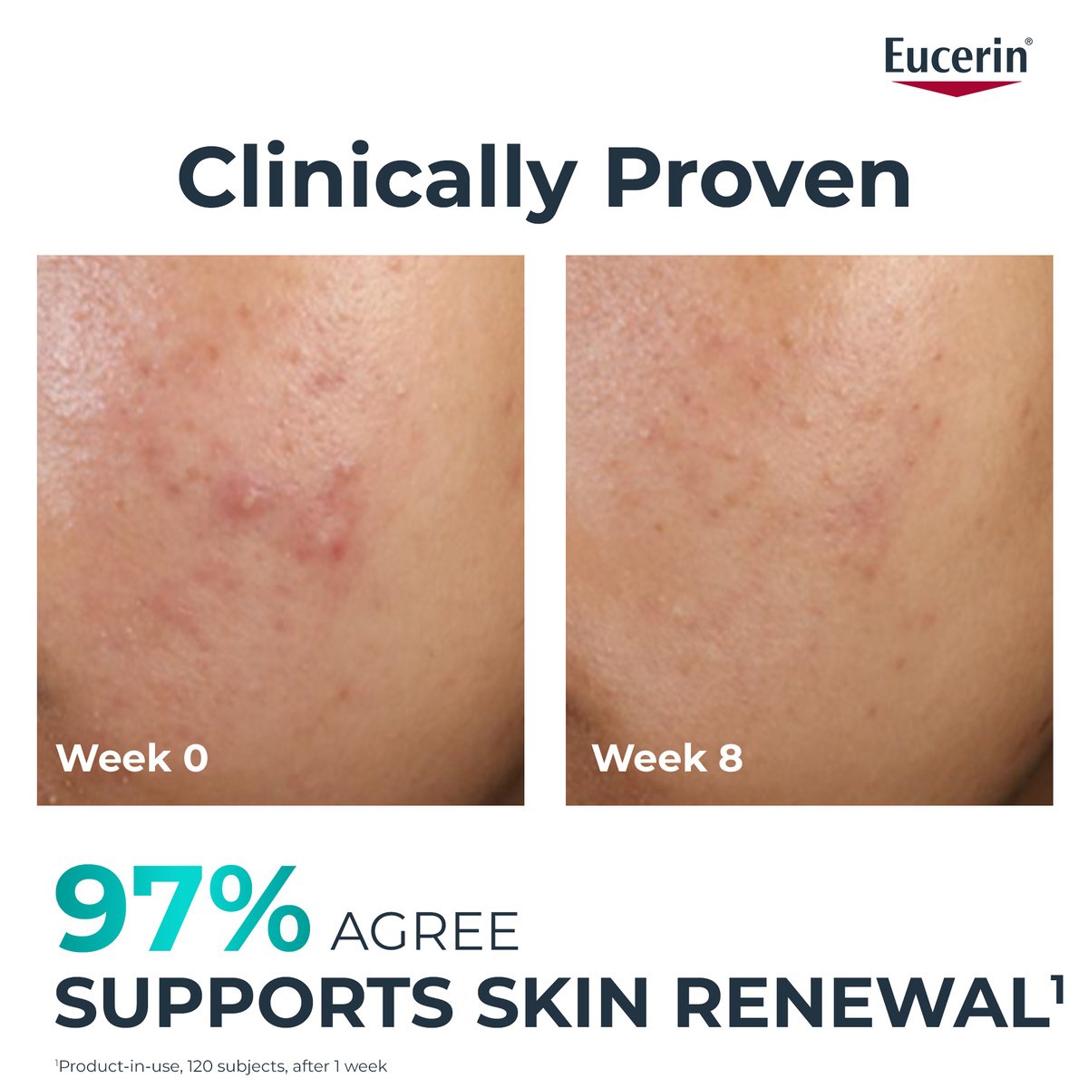 Eucerin DERMOPURE Clinical Peeling 10 40ml