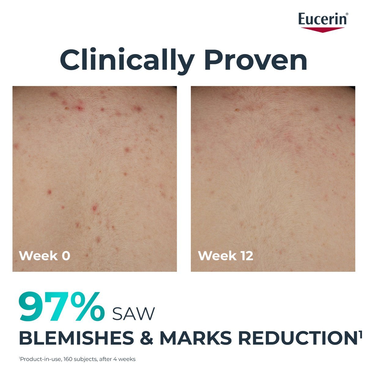 Eucerin DERMOPURE Clinical Correcting Body Care 200ml