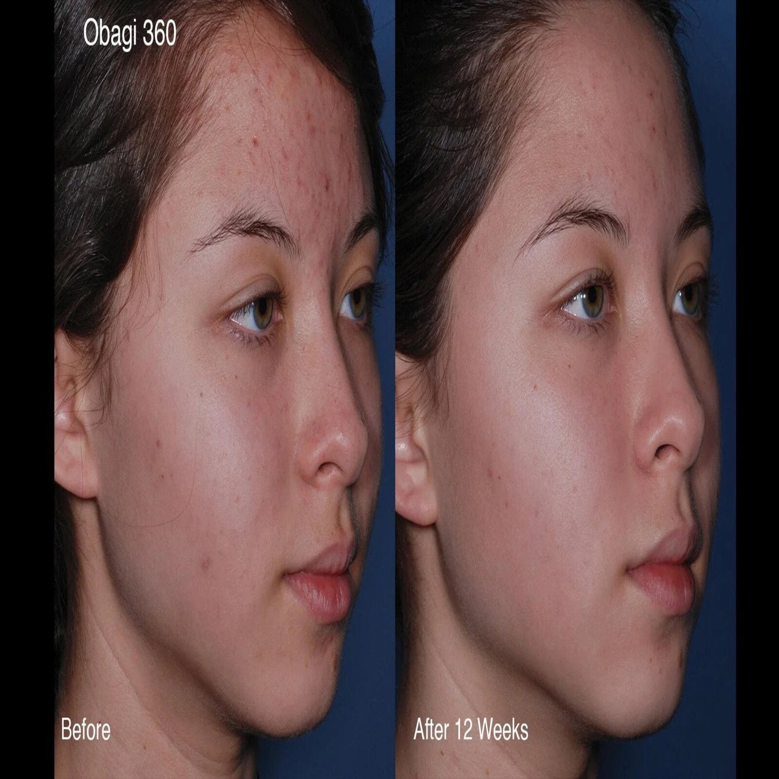 Obagi CLENZIderm M.D.® Daily Lightweight Foaming Blemish Cleanser 118ml