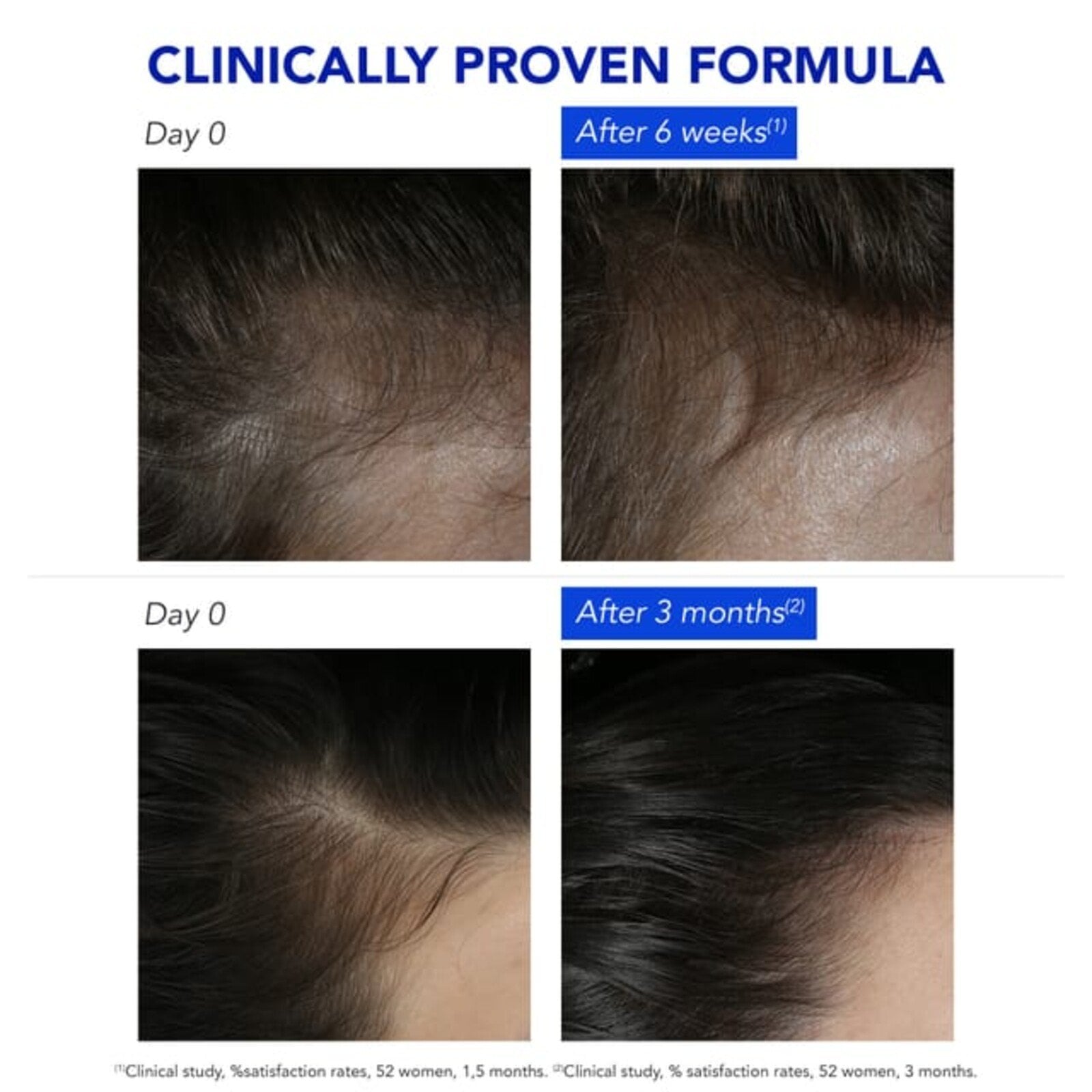 Phytophanere Anti-Reactive Hair Loss Treatment 12x5ml