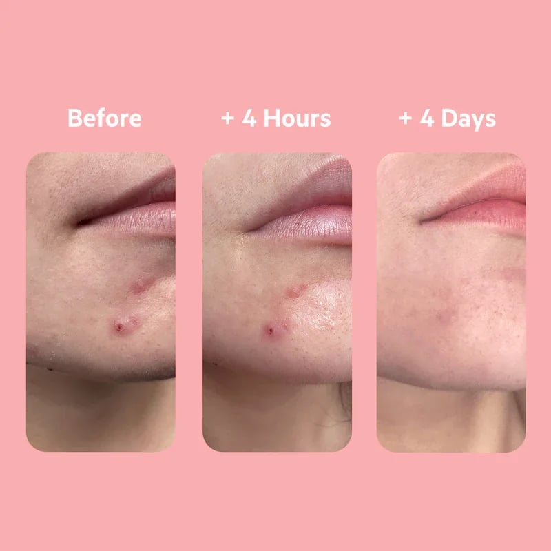 SVR [AZ] Sebiaclear Gel Flash 4h Stop-Pimples 15ml