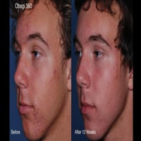 Obagi CLENZIderm M.D.® Daily Lightweight Foaming Blemish Cleanser 118ml