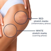 Rilastil Smagliature Stretch Marks Ampoules 10x5ml