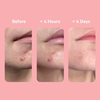 SVR [AZ] Sebiaclear Gel Flash 4h Stop-Pimples 15ml
