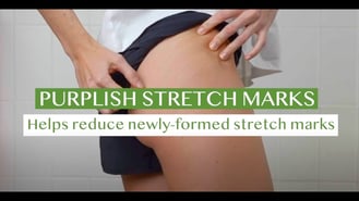 Elancyl Massage for stretch marks