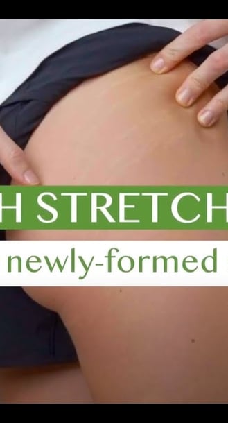 Elancyl Massage for stretch marks