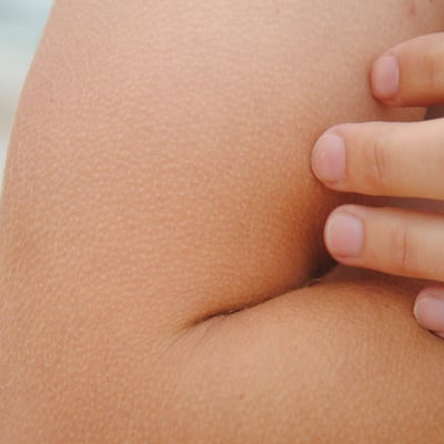 “Chicken Skin”? Here Are Our Best Keratosis Pilaris Creams & Lotions