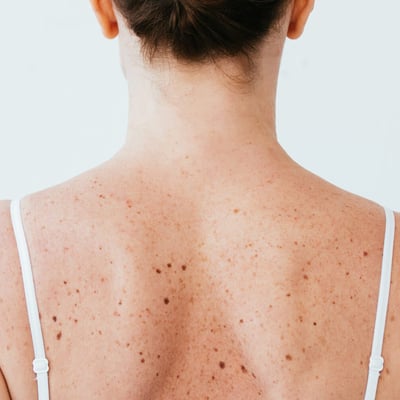 Pimples on Your Back? It’s Probably Bacne