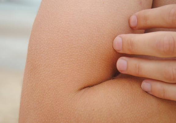 “Chicken Skin”? Here Are Our Best Keratosis Pilaris Creams & Lotions