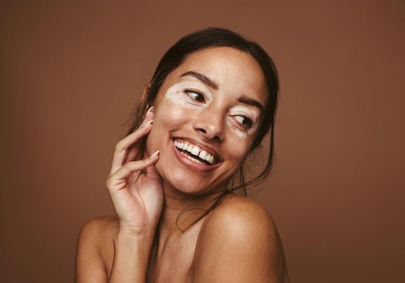 What is Vitiligo, & How Can You Manage It?