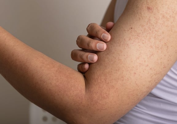 Try These Creams for “Chicken Skin”, aka Keratosis Pilaris