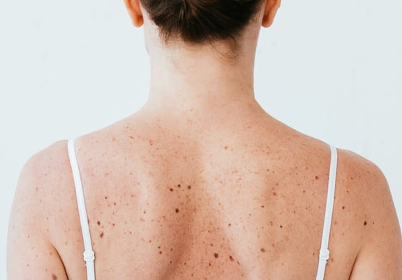Pimples on Your Back? It’s Probably Bacne