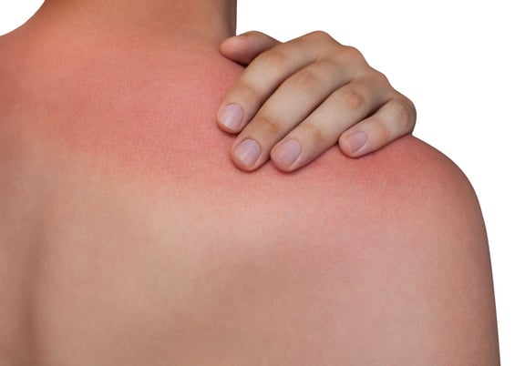 Sun Poisoning Explained: Symptoms, Prevention & Care