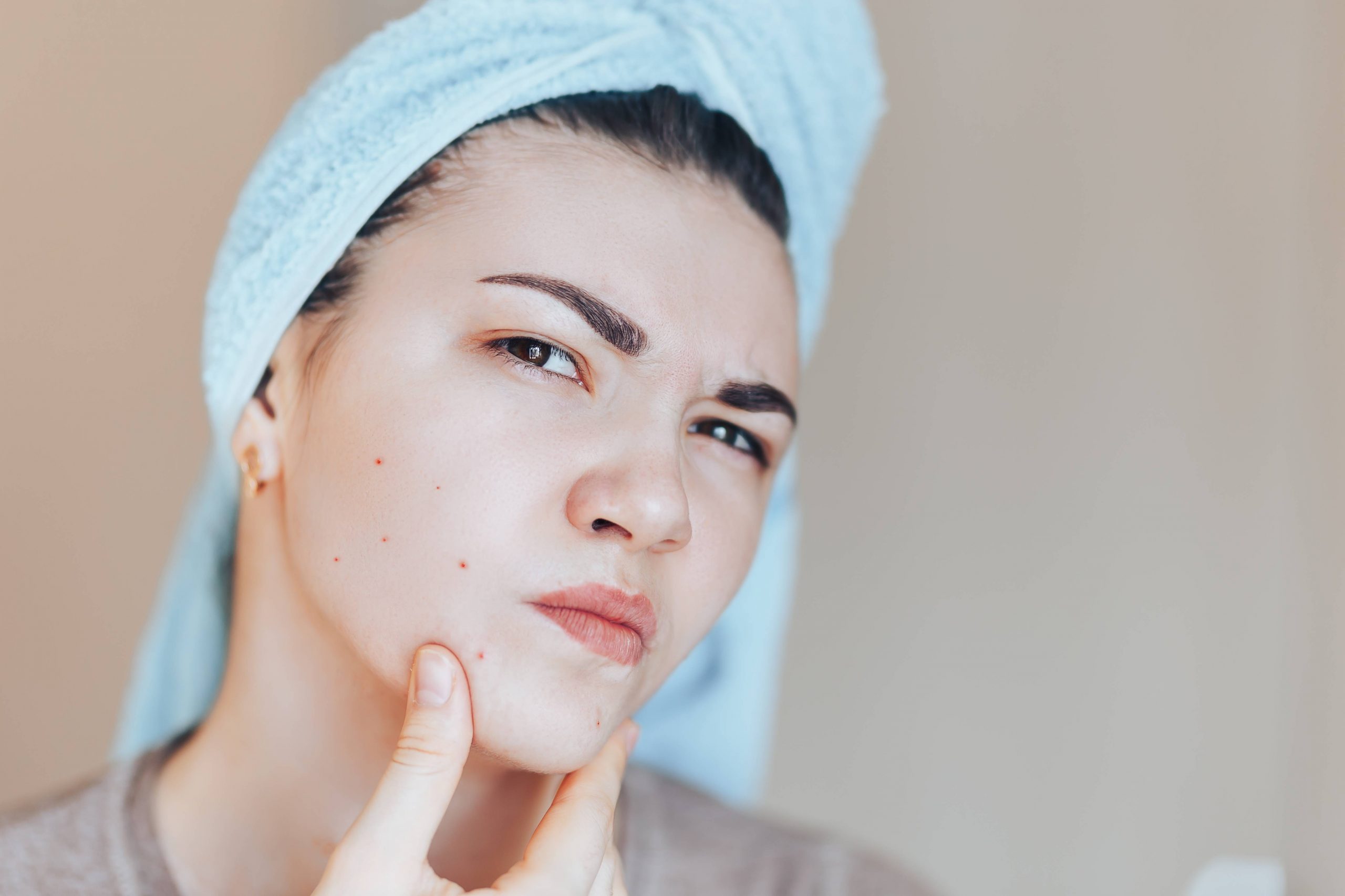 Top 7 Affordable Acne Products Under $20