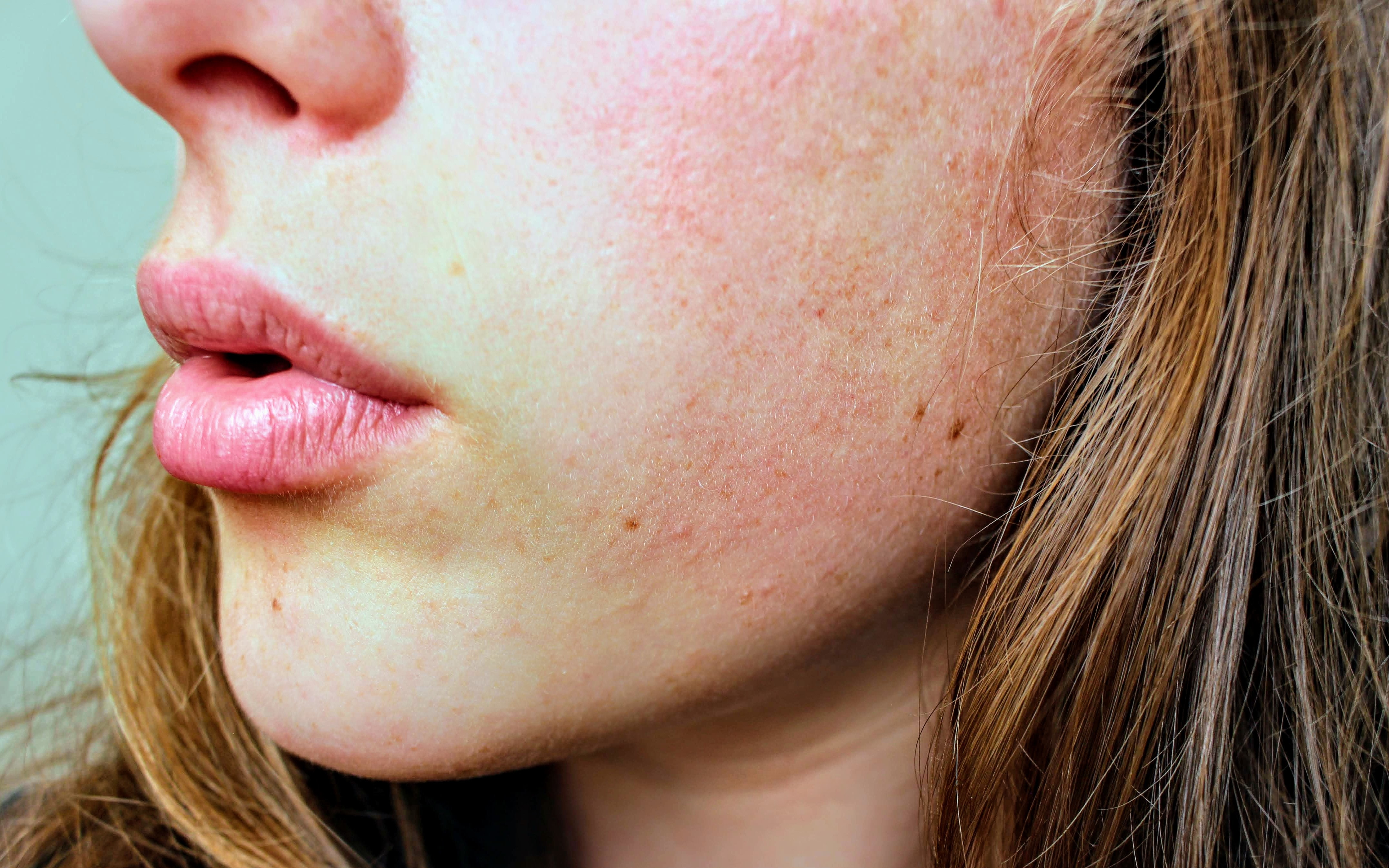 How to Repair Skin Barrier Damage